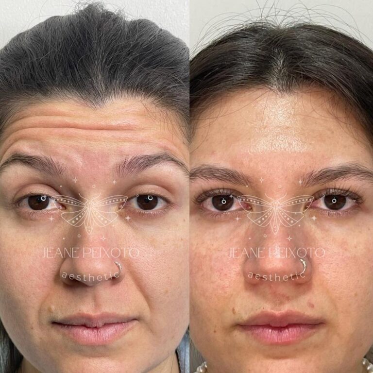 Botulinum Toxin