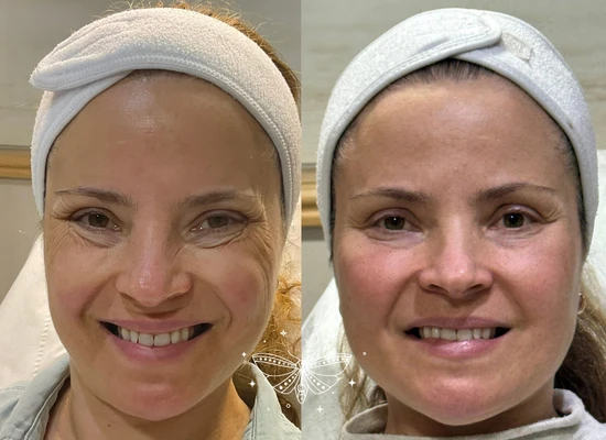 anti-wrinkle-treatment-clapham