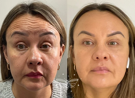 anti-wrinkle-treatment-clapham