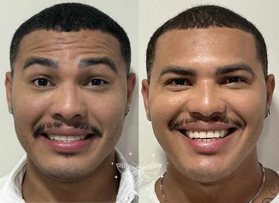 anti-wrinkle-treatment-clapham