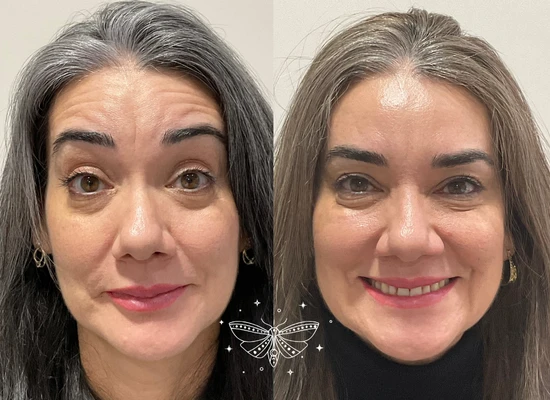 anti-wrinkle-treatment-clapham.webp