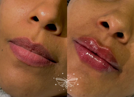 lip-filler-clapham-london.webp