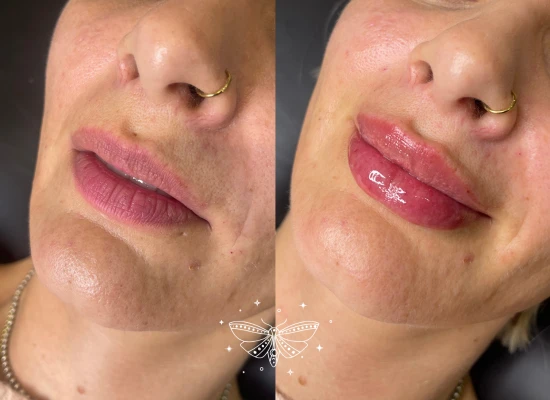 lip-filler-london.webp