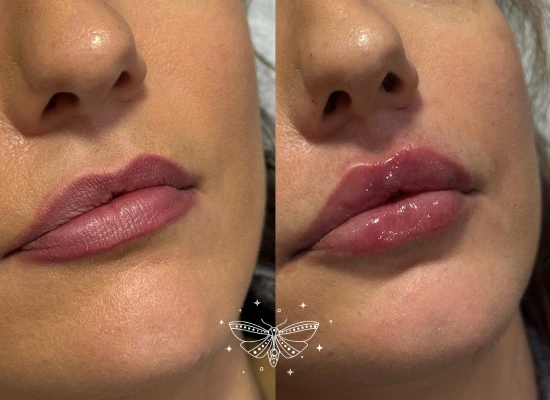 lip-filler-oval-london.webp
