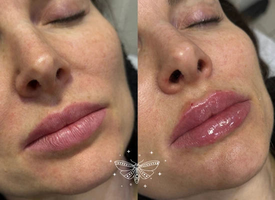 lip-filler-stockwell-london.webp