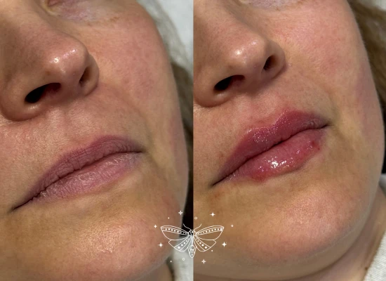 natural-lip-filler-london.webp