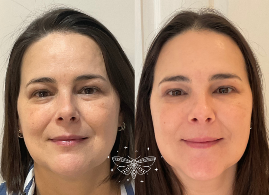 regenerative-facial-rejuvenation-london (1)