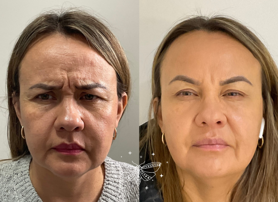 regenerative-facial-rejuvenation-london (2)