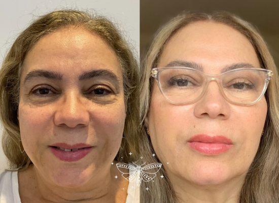 regenerative-facial-rejuvenation-london (3)