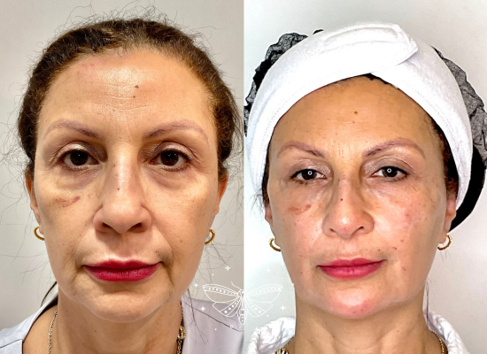 regenerative-facial-rejuvenation-london (4)